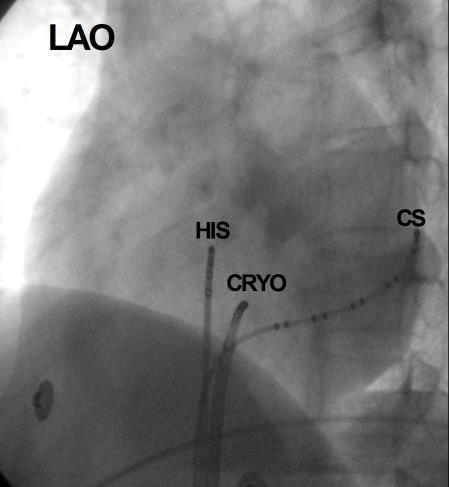 Ablation av AVNRT posterior modifiering Katerplacering vid posterior modifiering Tidigt