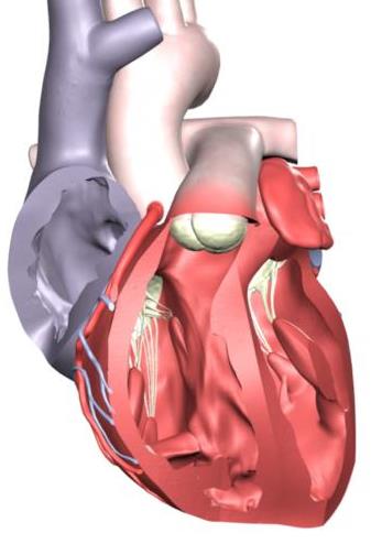 RVOT-VT Lättbehandlad takykardi viktig att identifiera Bild som vid LBBB och inferior axel.