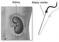 Njurbiopsi Njurmissbildigar Aplasi: Njure har ite alagts.