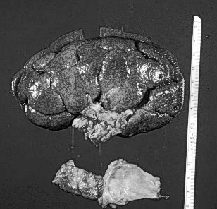 Nefrotiskt sydrom Albumiuri Hypoalbumiemi Ödem Hyperlipidemi (Dessutom