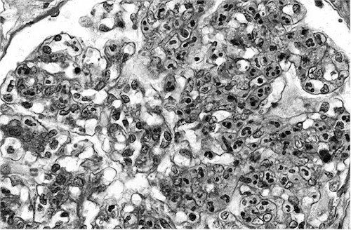 Glomeruloefrit Diabetesefropati - förekomst De valigaste orsake till kroisk jursvikt. 1/3 av alla diabetespat.