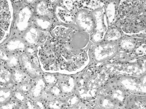 Diabetesefropati symtom, förlopp, utredig, behadlig Hyperfiltratio med albumiuri och utvecklig av hypertoi. Seda miskat GFR och utvecklig av jursvikt. Regelbude kotroll av albumiutsödrige.