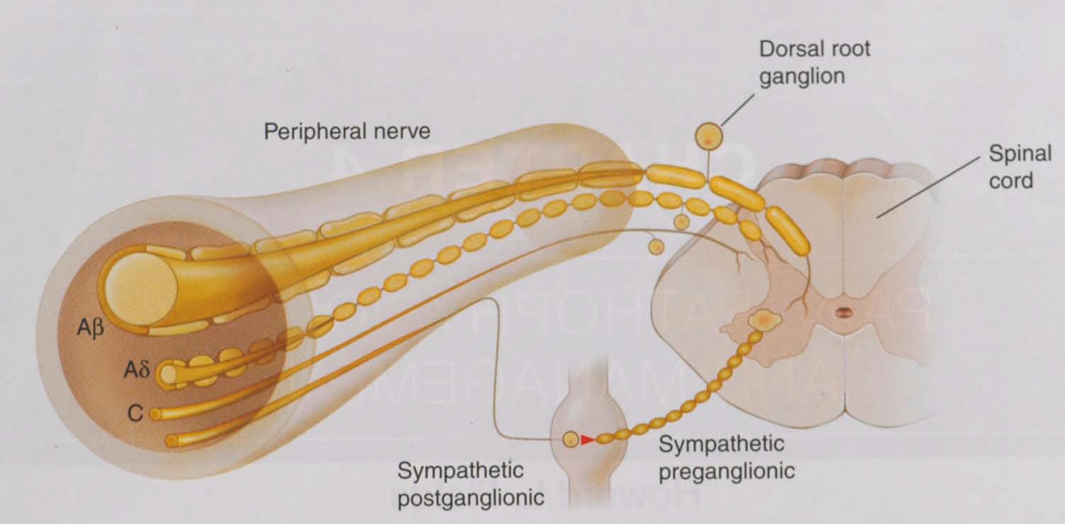 Perifera nerver mest sårbart är tunna fibrer för smärta, temperatur och autonom nerver Beröring Kyla,