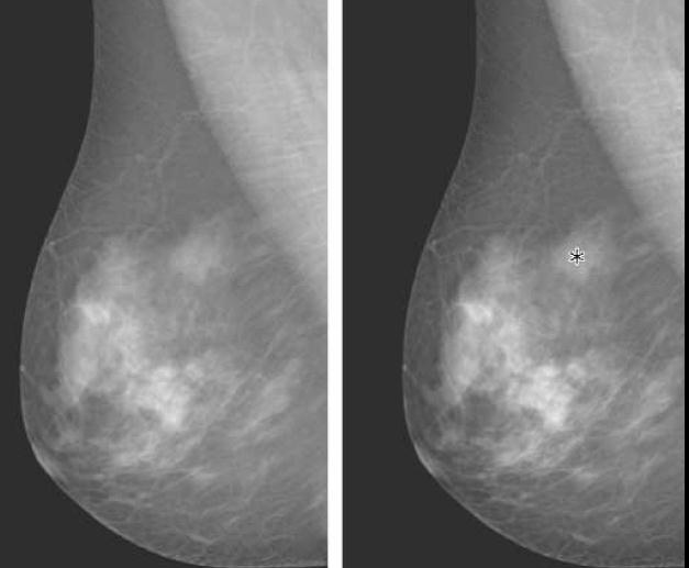 återkallelsefrekvensen i Europa på fem procent överstigs, alltså antal kvinnor som blir återkallade kliniskt för vidare utredning från mammografiscreening.