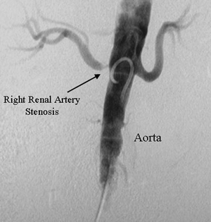 Renovaskulära sjukdomar - diagnos n