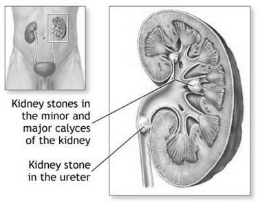 Kirurgiska sjukdomar i njurar, urinvägar, prostata n Njursten: Kalciumstenar; infektionsstenar