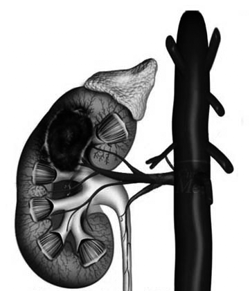 Renal anemi n Vilken är orsaken till