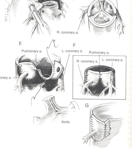 Transposition neonatalt Prenatal transport Prostivas