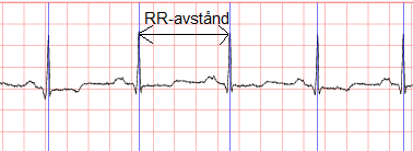10 TEORI OCH BAKGRUND T-vågen: Tyder på repolarisering av kamrarna [6, 11]. 2.3.5 RR-avstånd Avståndet mellan två R-vågor kallas för RR-avstånd vilket anges i ms (figur 8).