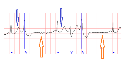 30 METODER Figur 27: Blå pil visar på start av rytmändringen där RR-avståndet blir plötsligt kortare än föregående.