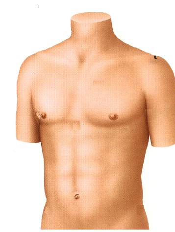 Elektrodplacering 12-avlednings EKG R L C 1 C 2 C 3 C 4 C 5 C 6 N F R Röd På höger sida av bröstkorgens övre del, strax nedanför nyckelbenet.