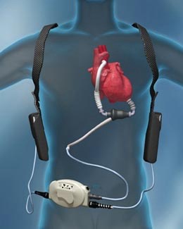 HLR på patient med Hjärtpump (HeartMate II ) Hjärtmassage är kontraindicerat! De ska inte ha adrenalin!