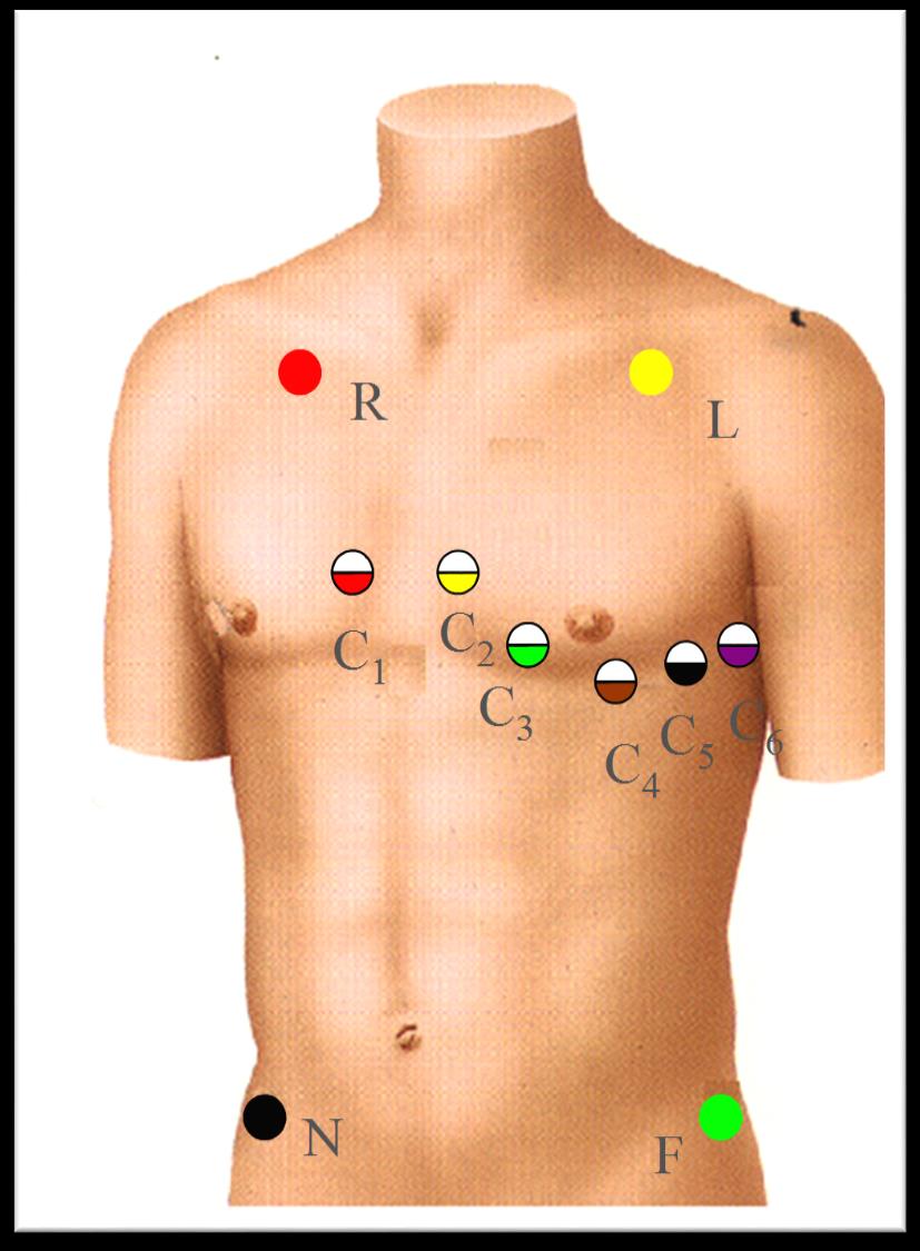 EKG EKG-TAGNING INDIKATIONER/KRITERIER FÖR 12-AVLEDNINGS EKG Misstanke om hjärtinfarkt: - Pågående bröstsmärta > 15 min - Svår bröstsmärta > 15 min senaste 6 timmarna - Andnöd de senaste 6 timmarna