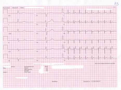 EKG -