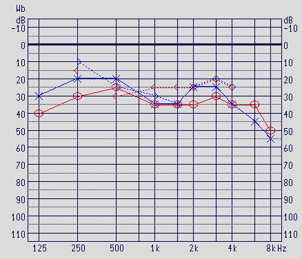 Schuknecht s classification