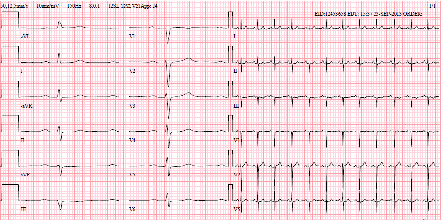 EKG 1 EKG