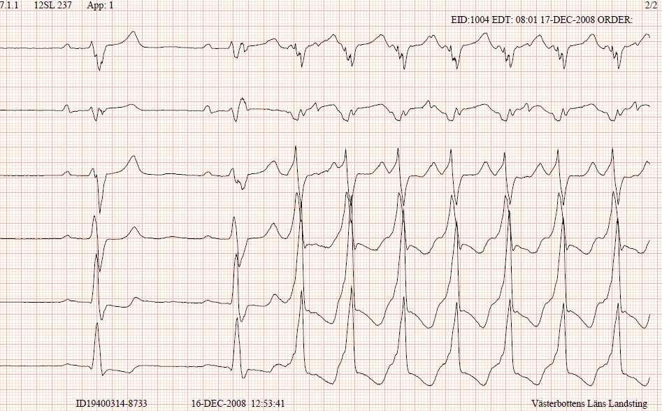 takykardi LBBB.