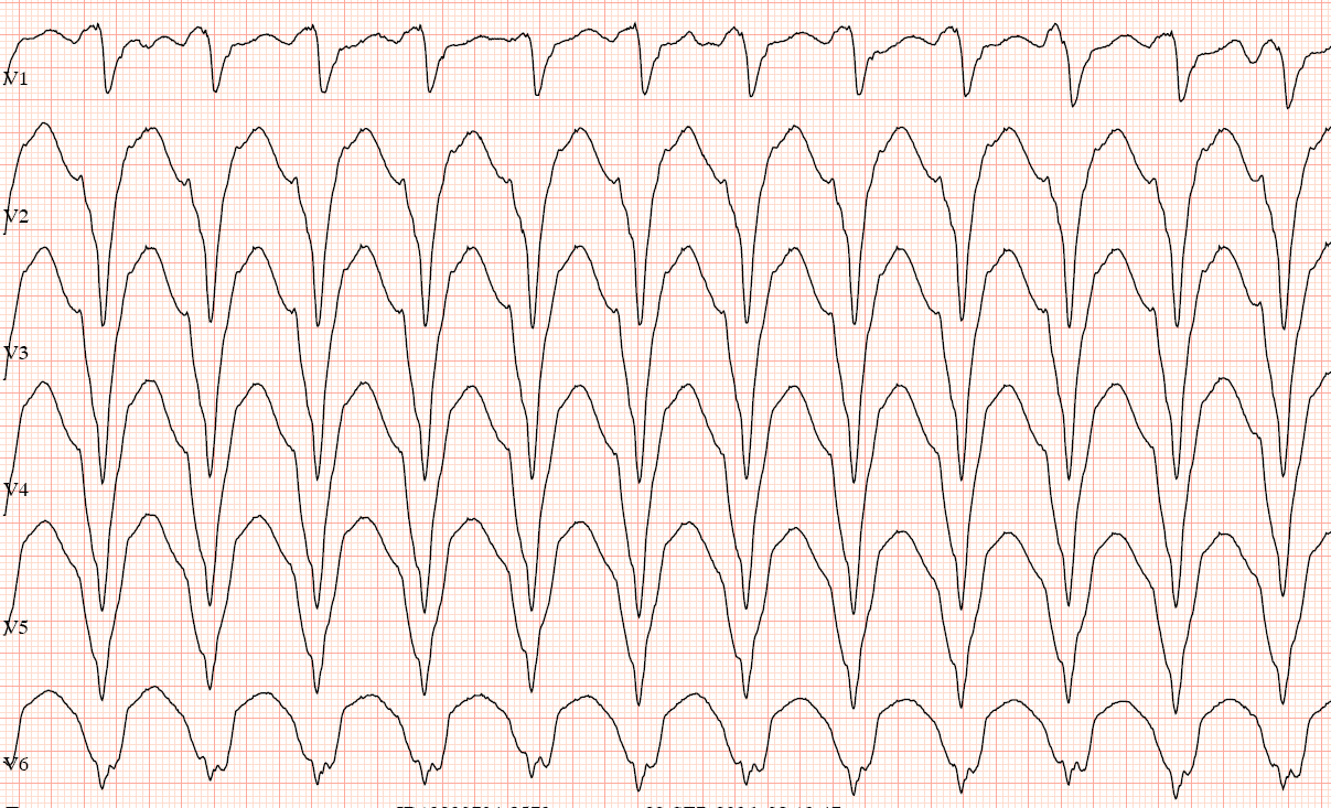 På akuten Sinus, LBBB