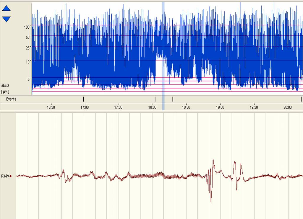 Atlas of aeeg in the Newborn.