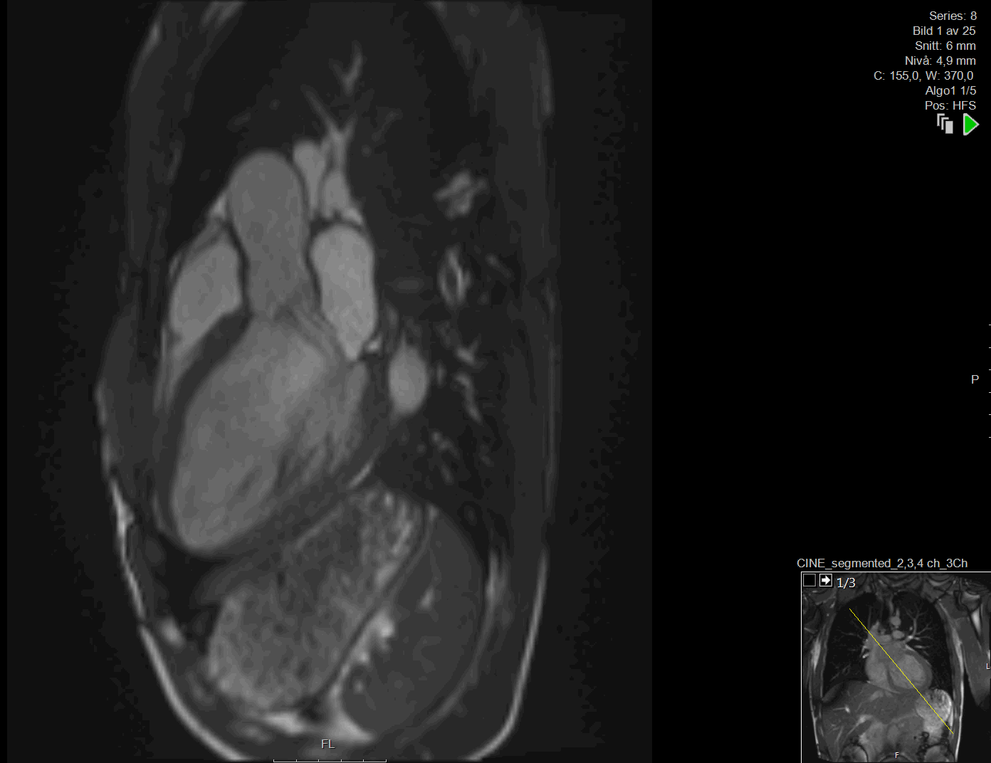 Lund Cardiac MR group Måttligt dilaterad vänsterkammare med bevarad systolisk funktion.