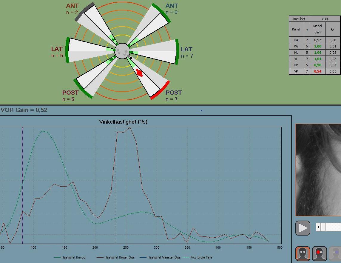VHIT Alla vestibulära test medför felmätningar Man kan inte lita blint på gain värderna!