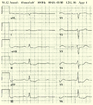 STEMI. Ett tidigare känt LBBB skapar problem, eftersom det maskerar en ny ischemi eller infarkt. Ischemilokalisation. EKG indikerar också ischemilokalisationen och därmed drabbat kranskärl.