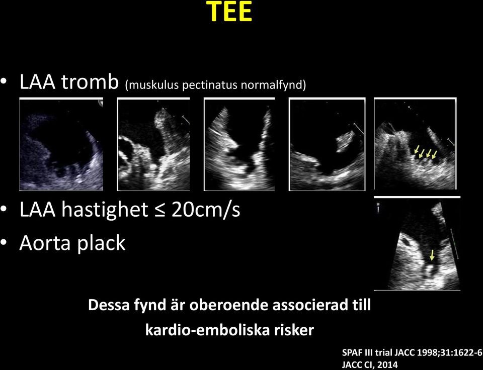 oberoende associerad till kardio-emboliska