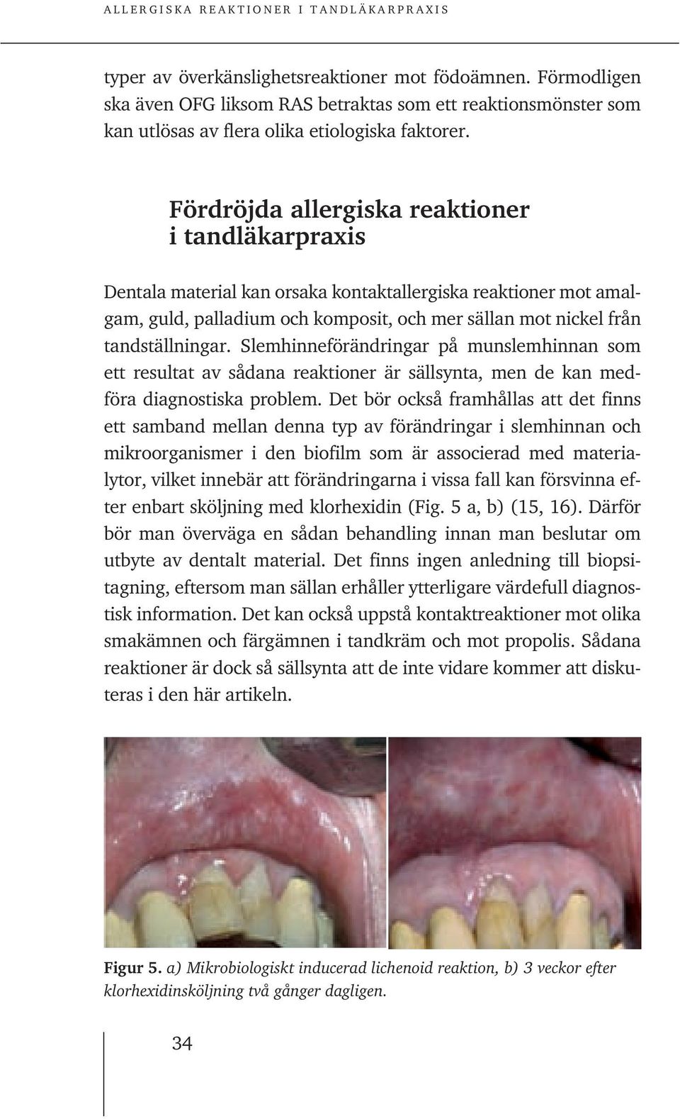 Slemhinneförändringar på munslemhinnan som ett resultat av sådana reaktioner är sällsynta, men de kan medföra diagnostiska problem.