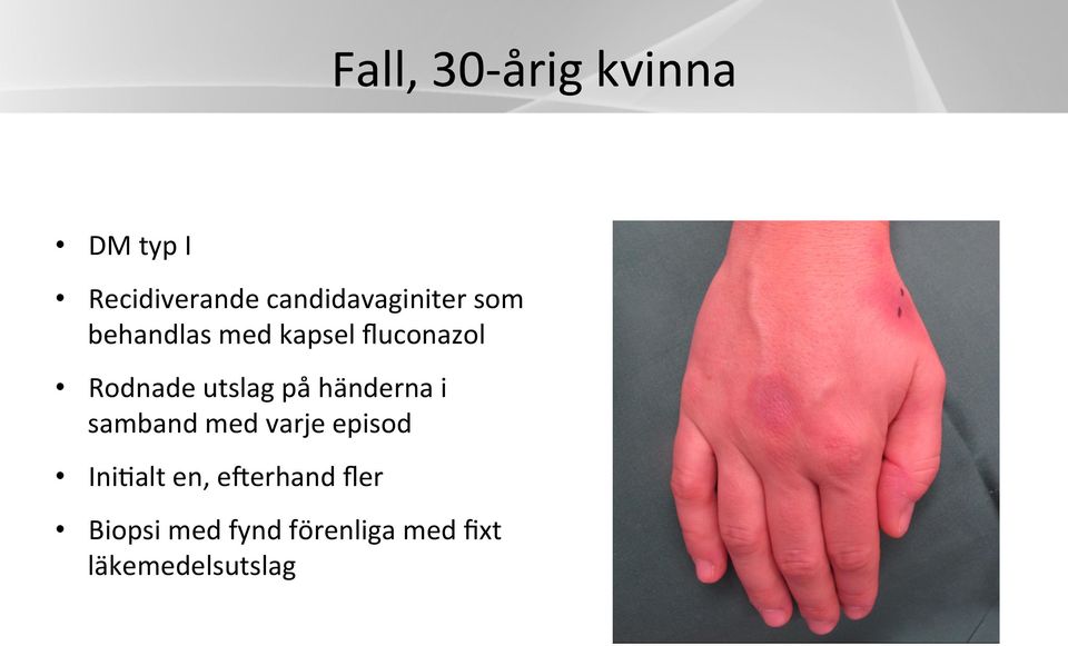 Rodnade utslag på händerna i samband med varje episod