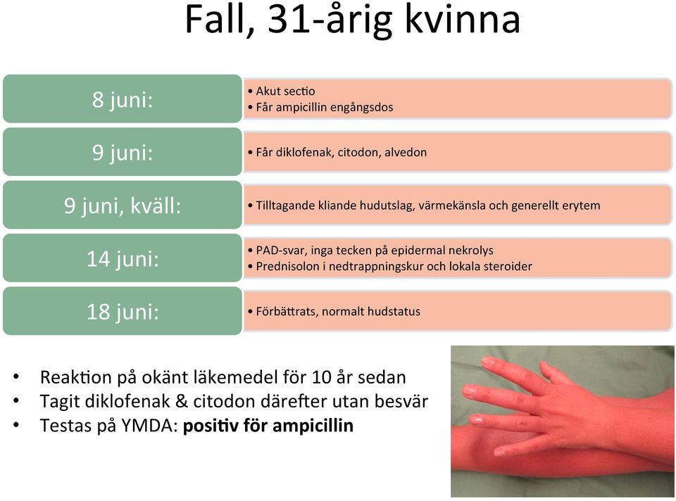 tecken på epidermal nekrolys Prednisolon i nedtrappningskur och lokala steroider FörbäIrats, normalt hudstatus