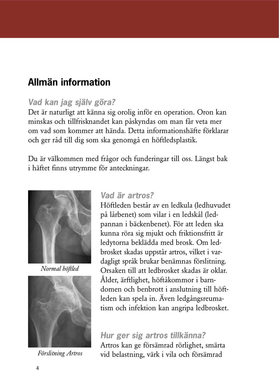 Normal höftled Vad är artros? Höftleden består av en ledkula (ledhuvudet på lårbenet) som vilar i en ledskål (ledpannan i bäckenbenet).
