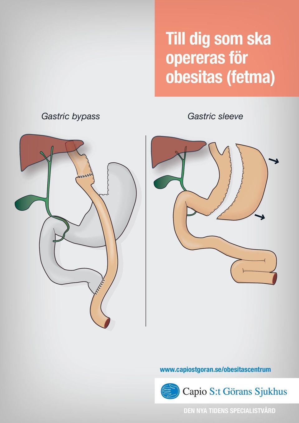 Gastric sleeve www.capiostgoran.