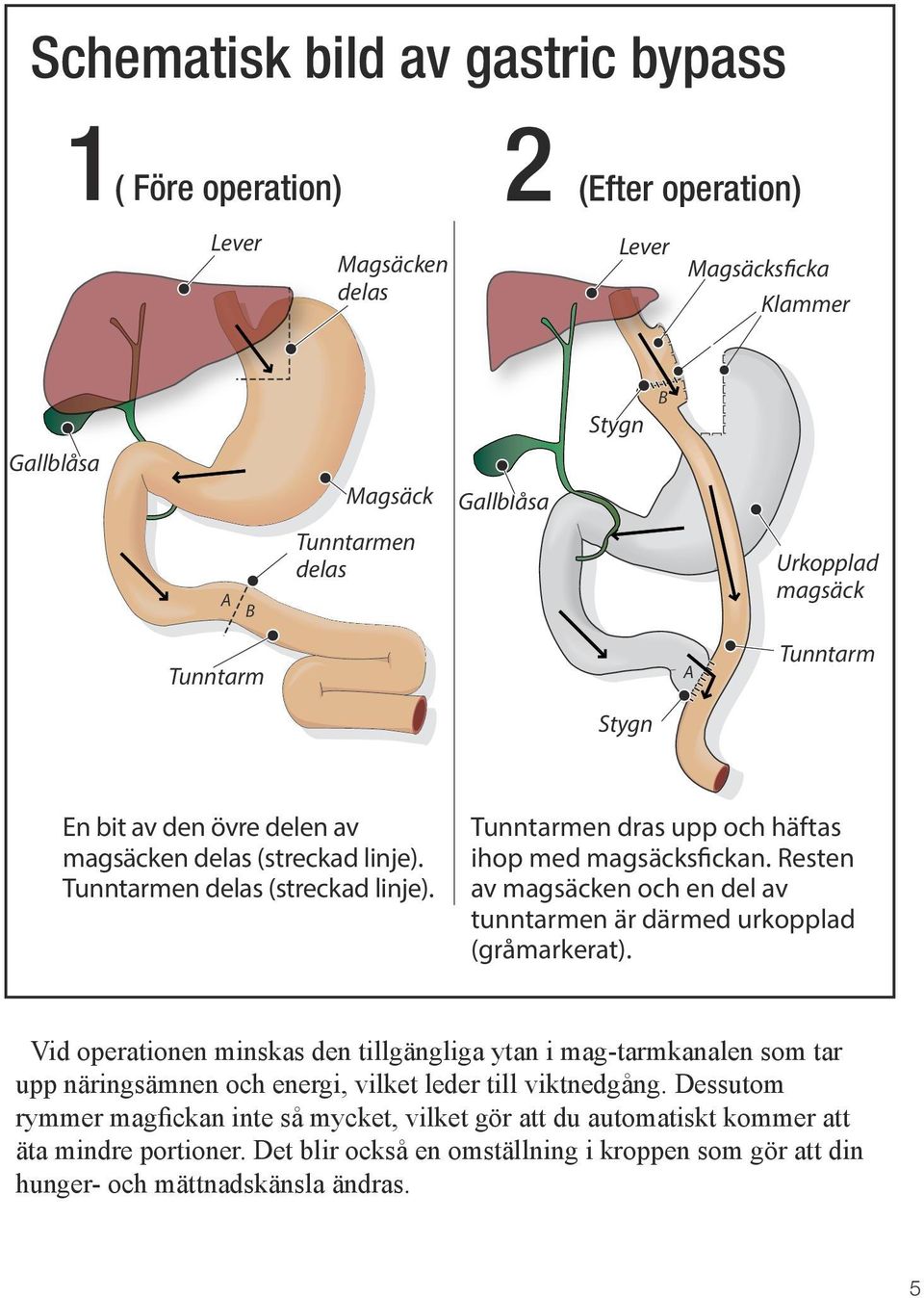 Resten av magsäcken och en del av tunntarmen är därmed urkopplad (gråmarkerat).