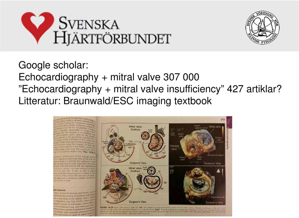 mitral valve insufficiency 427 artiklar?