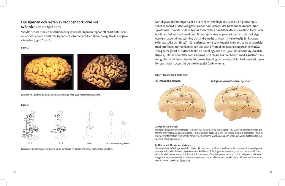 Figur 2 De tidigaste förändringarna är de som sker i tinningloben, särskilt i hippocampus, vilket sannolikt är den viktigaste skadan som orsakar det försämrade minnet.