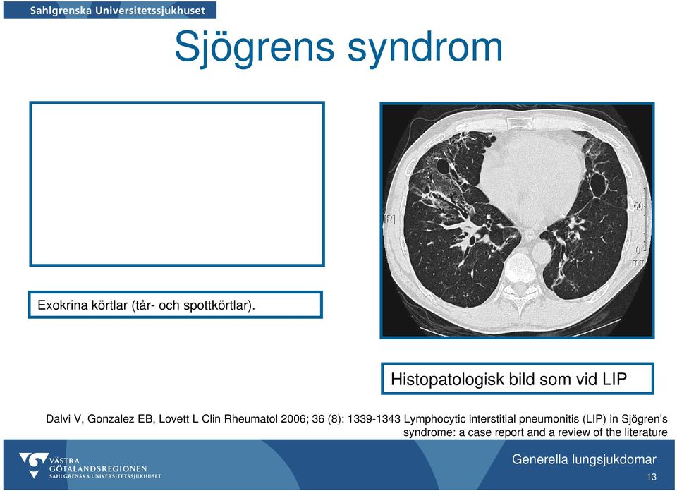 Rheumatol 2006; 36 (8): 1339-1343 Lymphocytic interstitial