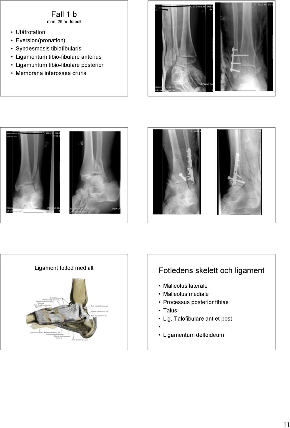 cruris Ligament fotled medialt Fotledens skelett och ligament Malleolus laterale Malleolus