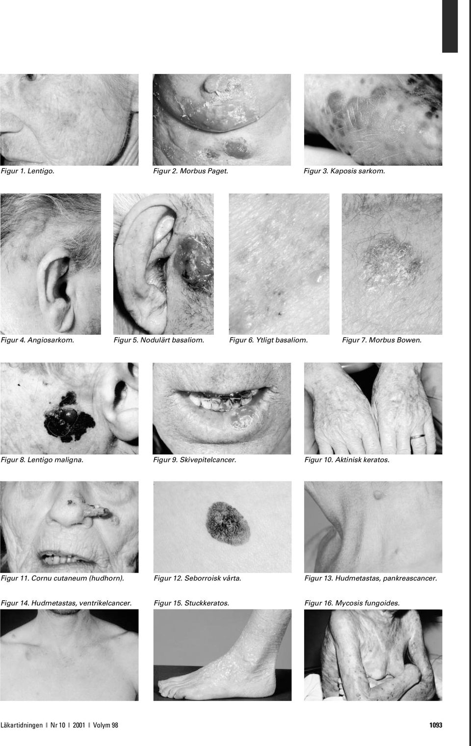 Aktinisk keratos. Figur 11. Cornu cutaneum (hudhorn). Figur 12. Seborroisk vårta. Figur 13. Hudmetastas, pankreascancer.