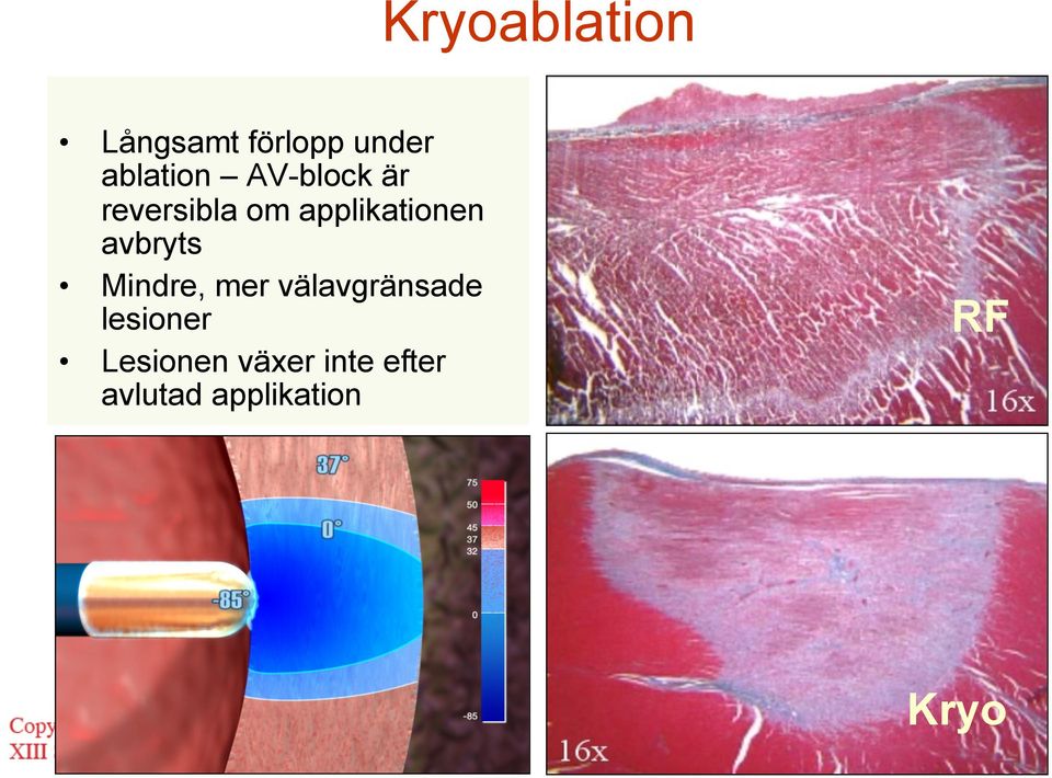 avbryts Mindre, mer välavgränsade lesioner