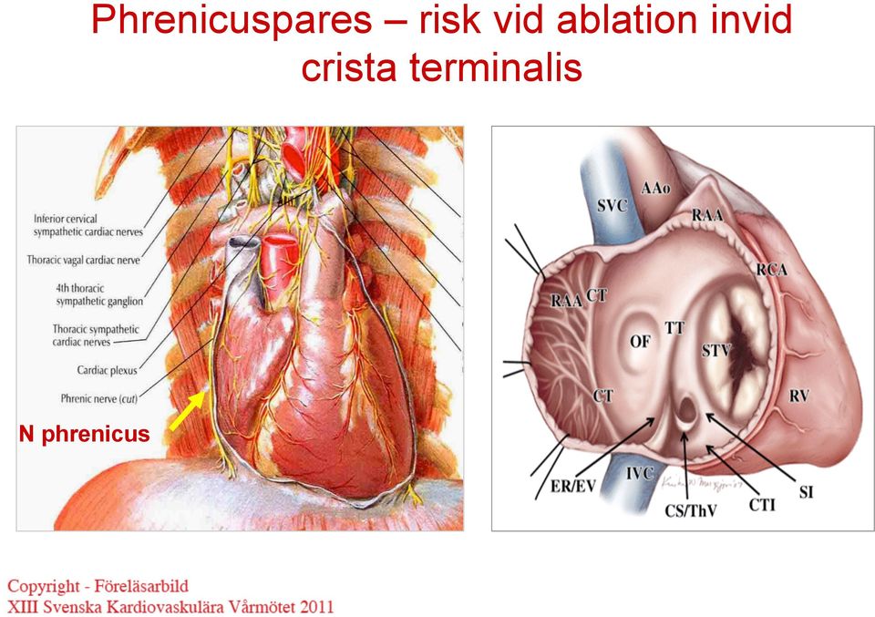 ablation invid