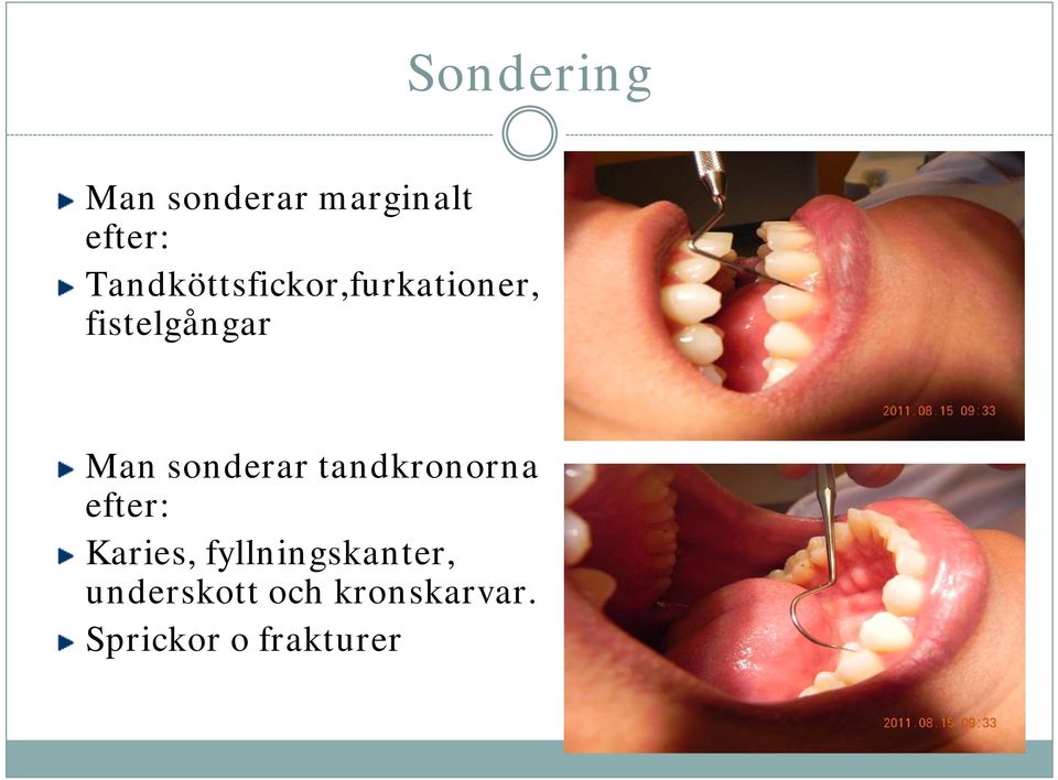 sonderar tandkronorna efter: Karies,