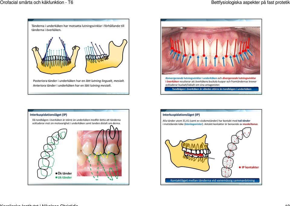 Konvergerande lutningsvinklar i underkäken och divergerande lutningsvinklar i överkäken resulterar att överkäkens buckala kuspar och framtändernas kronor ockluderar buckalt/labialt om sina