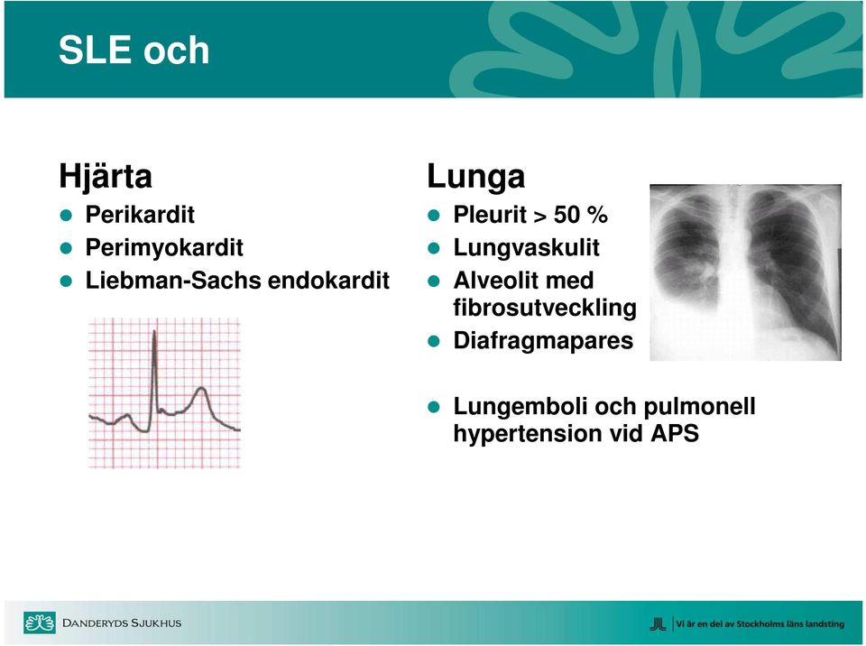 Lungvaskulit Alveolit med fibrosutveckling