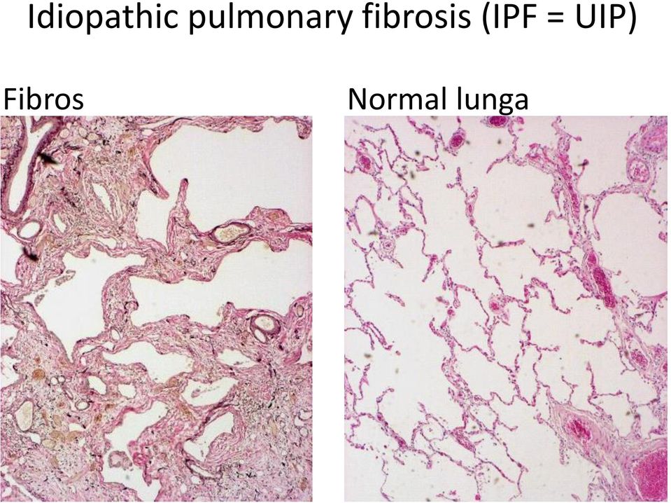 fibrosis (IPF =