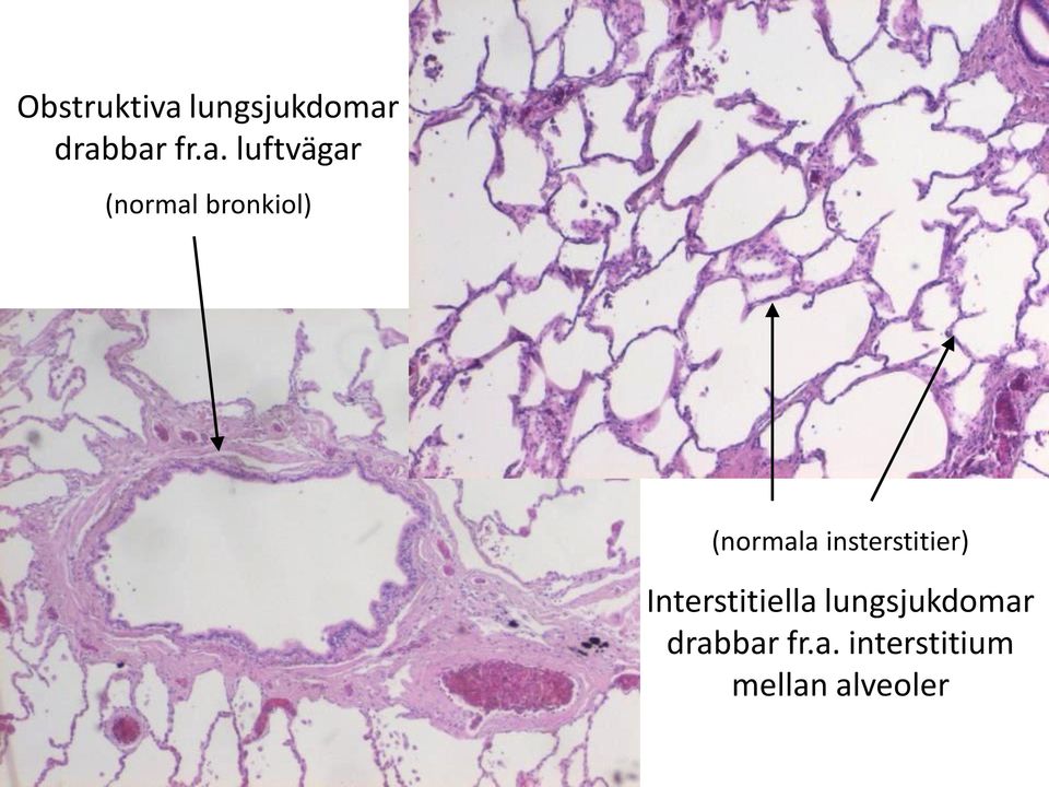 drabbar fr.a. luftvägar (normal