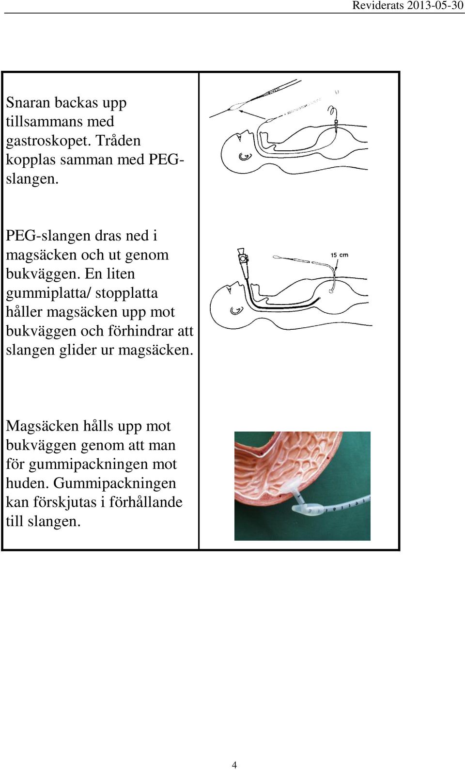 En liten gummiplatta/ stopplatta håller magsäcken upp mot bukväggen och förhindrar att slangen