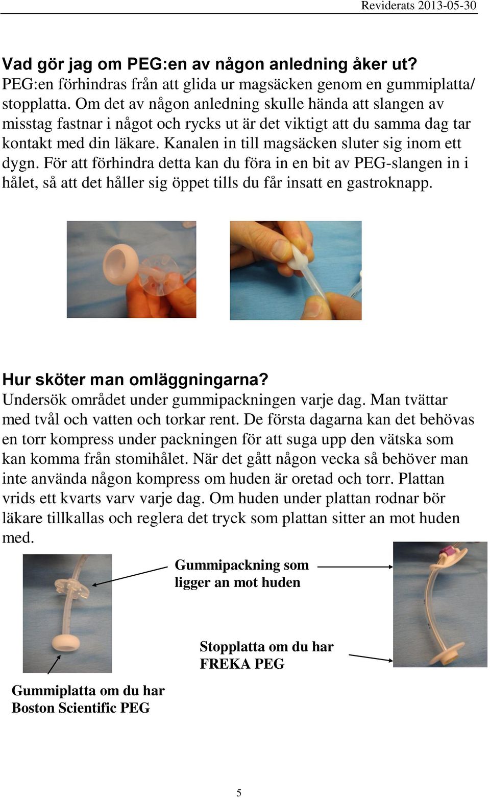 Kanalen in till magsäcken sluter sig inom ett dygn. För att förhindra detta kan du föra in en bit av PEG-slangen in i hålet, så att det håller sig öppet tills du får insatt en gastroknapp.