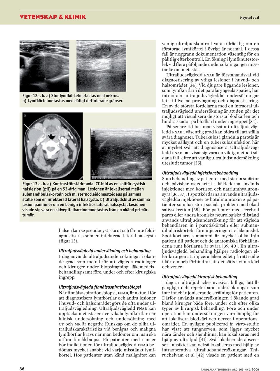 sternocleidomastoideus på samma ställe som en infekterad lateral halscysta. b) Ultraljudsbild av samma lesion påminner om en benign infektiös lateral halscysta.