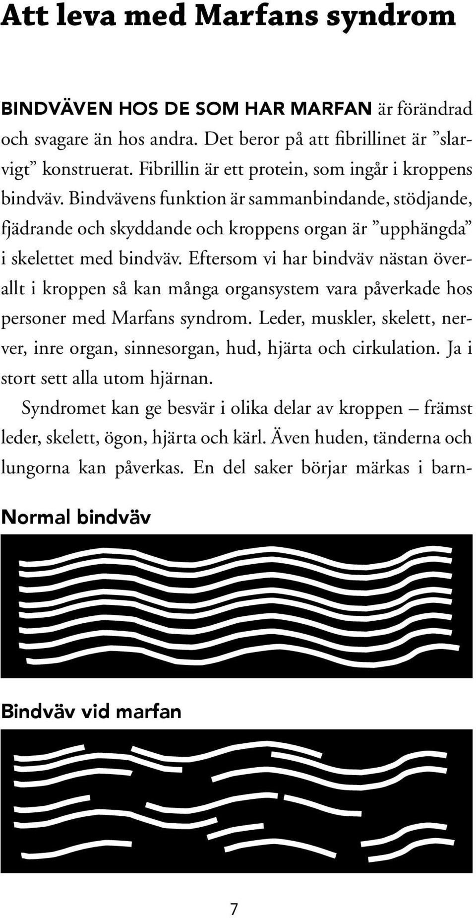 Eftersom vi har bindväv nästan överallt i kroppen så kan många organsystem vara påverkade hos personer med Marfans syndrom.