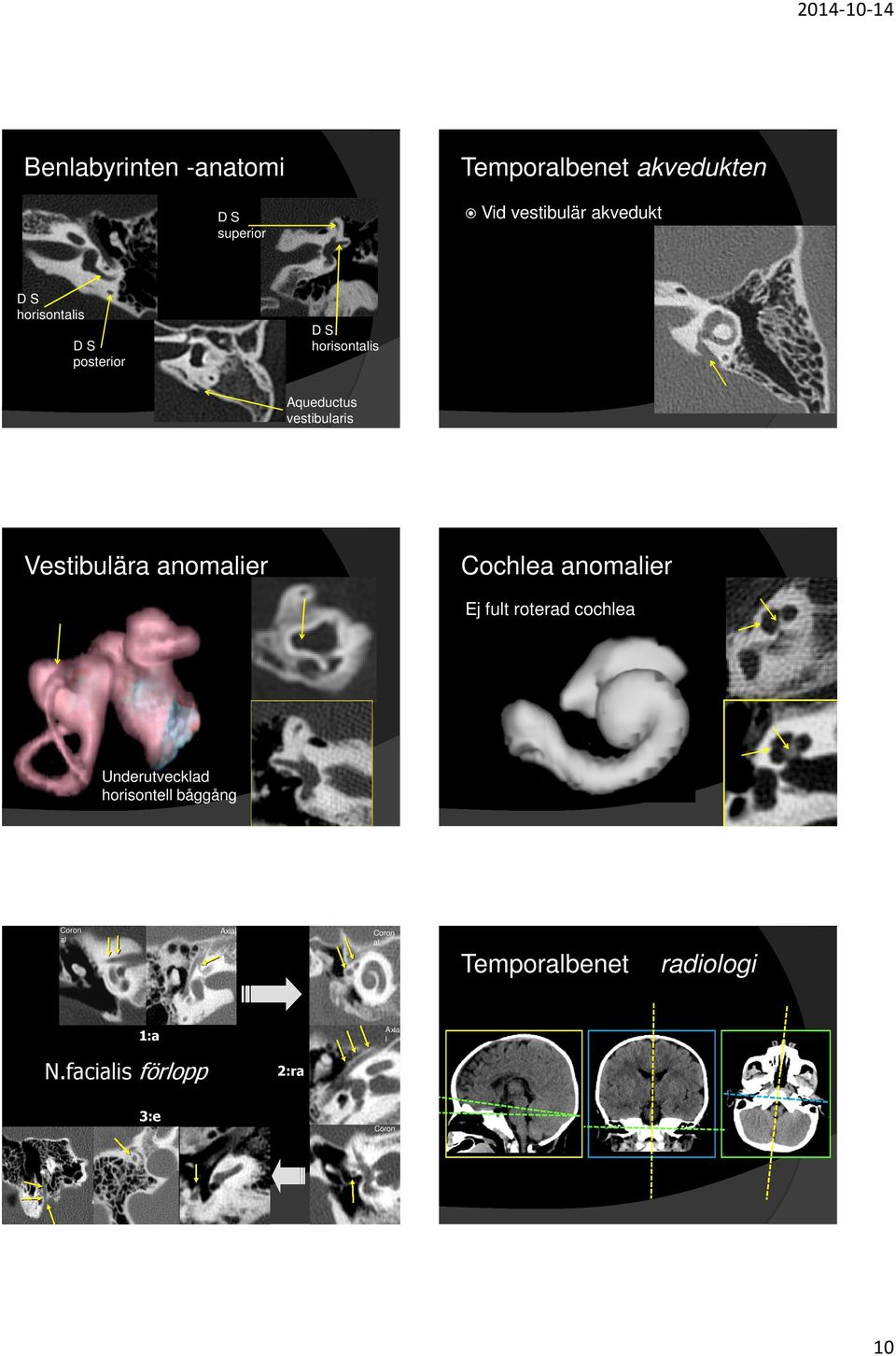 Cochlea anomalier Ej fult roterad cochlea Underutvecklad horisontell båggång Coron al